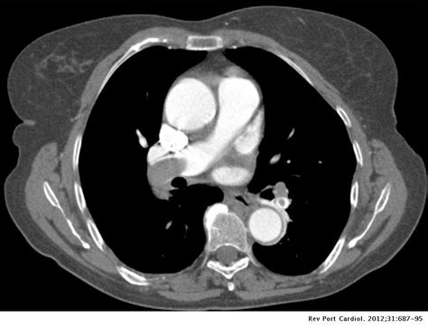 right ventricular thrombus ICD 10